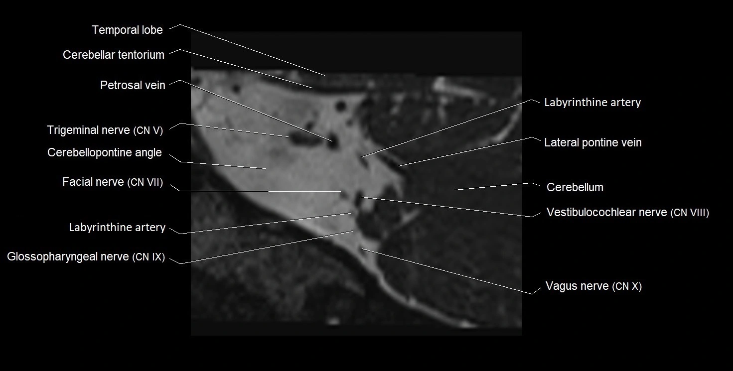 Internal auditory meatus (IAM) 3T sagittal cross sectional anatomy image 38.webp